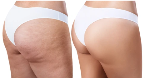 4 in 1 Cellulite Massager Remover for Belly Waist Arm Leg Butt
